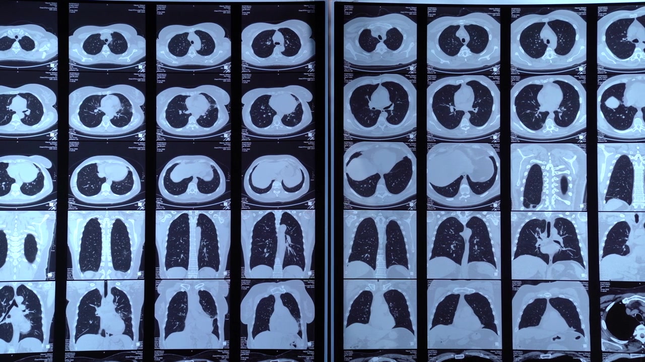 Diverse scansioni TC di polmoni umani per diagnosi medica