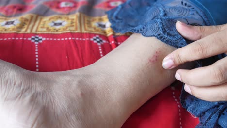 primer plano de la pierna de una mujer con una erupción roja o irritación de la piel