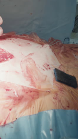 surgeon cuts threads around chest cavity. skilled doctors prepare area for closing incision after successful coronary artery bypass surgery closeup