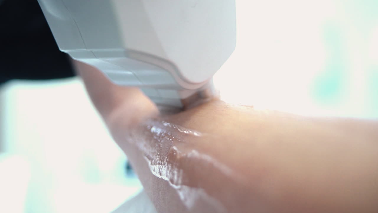 팔에 레이저 제거 절차