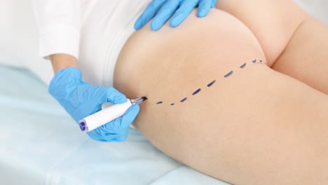 doctor marking patient's leg for cosmetic surgery procedure