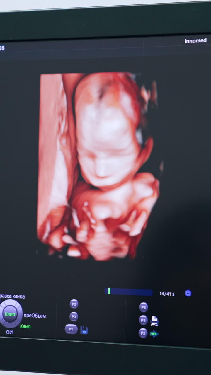 Immagine prenatale di un bambino sullo schermo di un'apparecchiatura ecografica. Diagnostica ecografica della gravidanza in clinica. Primo piano. Video verticale.