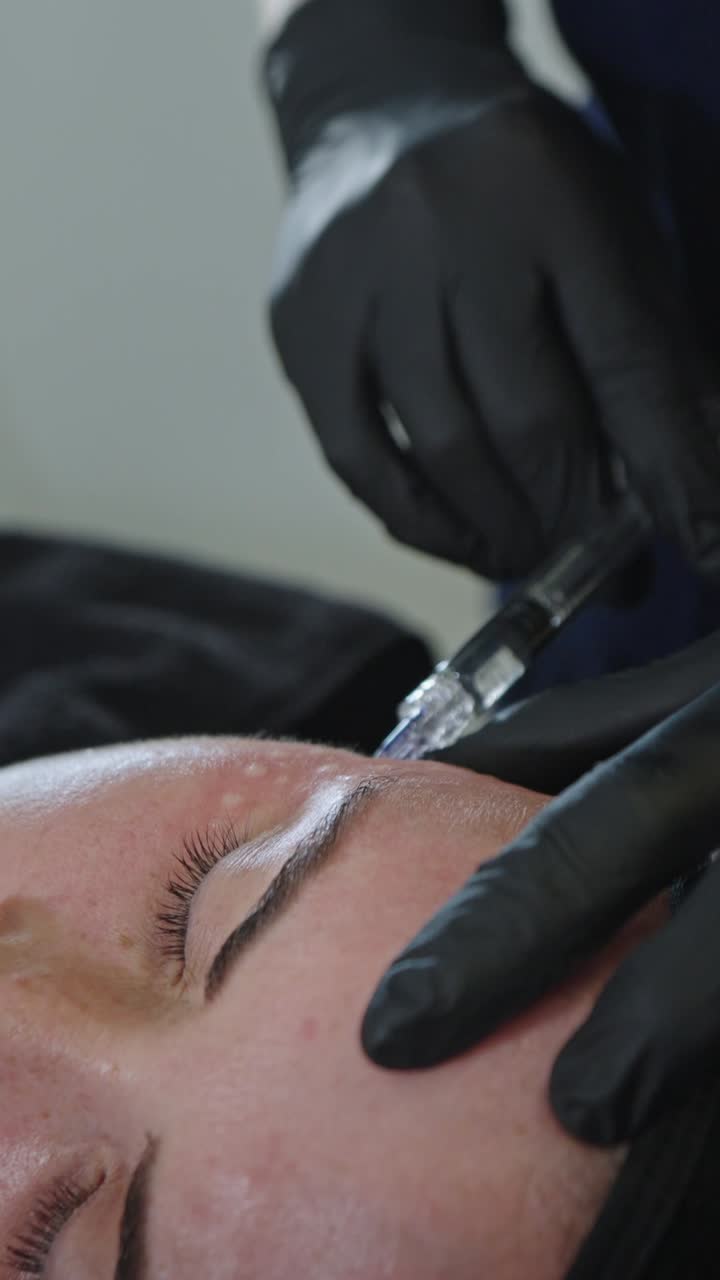 Eine Fachkraft für ästhetische Medizin in sterilen schwarzen Handschuhen hält eine feine Spritze und führt sorgfältig eine präzise Injektion von Polynukleotiden in den empfindlichen periorbitalen und Unteraugenbereich durch.