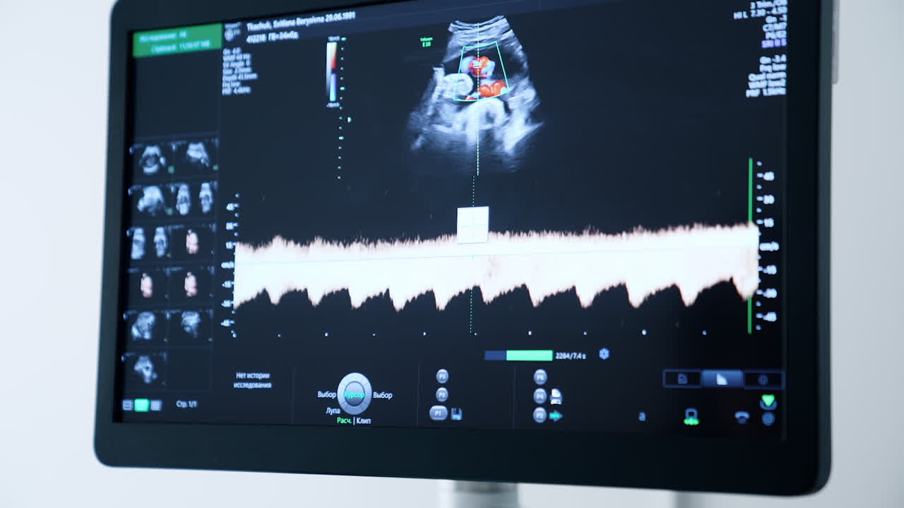 Black screen of ultrasonic equipment. Monitor showing fetal heartbeat. Close up.
