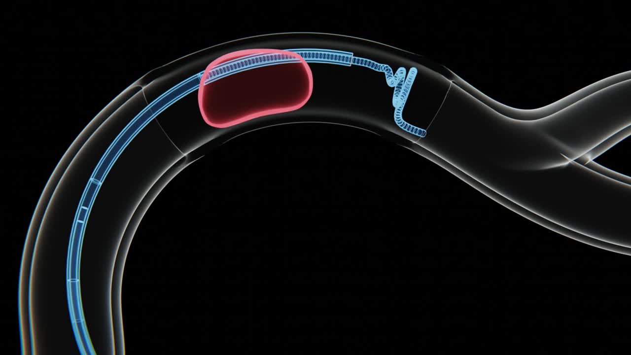 Trombectomia Meccanica (rimozione del coagulo) processo video a raggi X in 4K | Video di visualizzazione della Trombectomia Meccanica in raggi X HD.