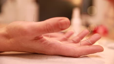 acupuncture treatment