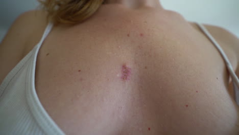 una herida que cicatriza y se convierte en cicatriz después de extirpar un quiste en el seno de una mujer