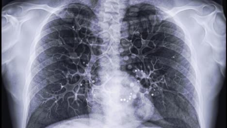 detailed x-ray of human lungs showcases the intricate structure of the respiratory system. this examination provides insight into potential abnormalities or conditions affecting lung health.