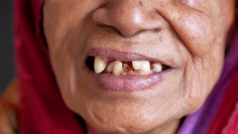 senior woman smiling with deformed teeth