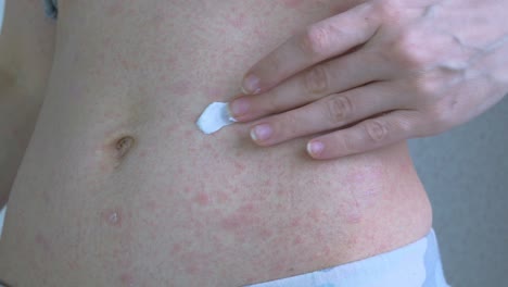 a little white allergy ointment is squeezed out of the tube. thoroughly rub the ointment on the stomach. on the skin, rashes of various sizes are pale pink. viral diseases. close-up