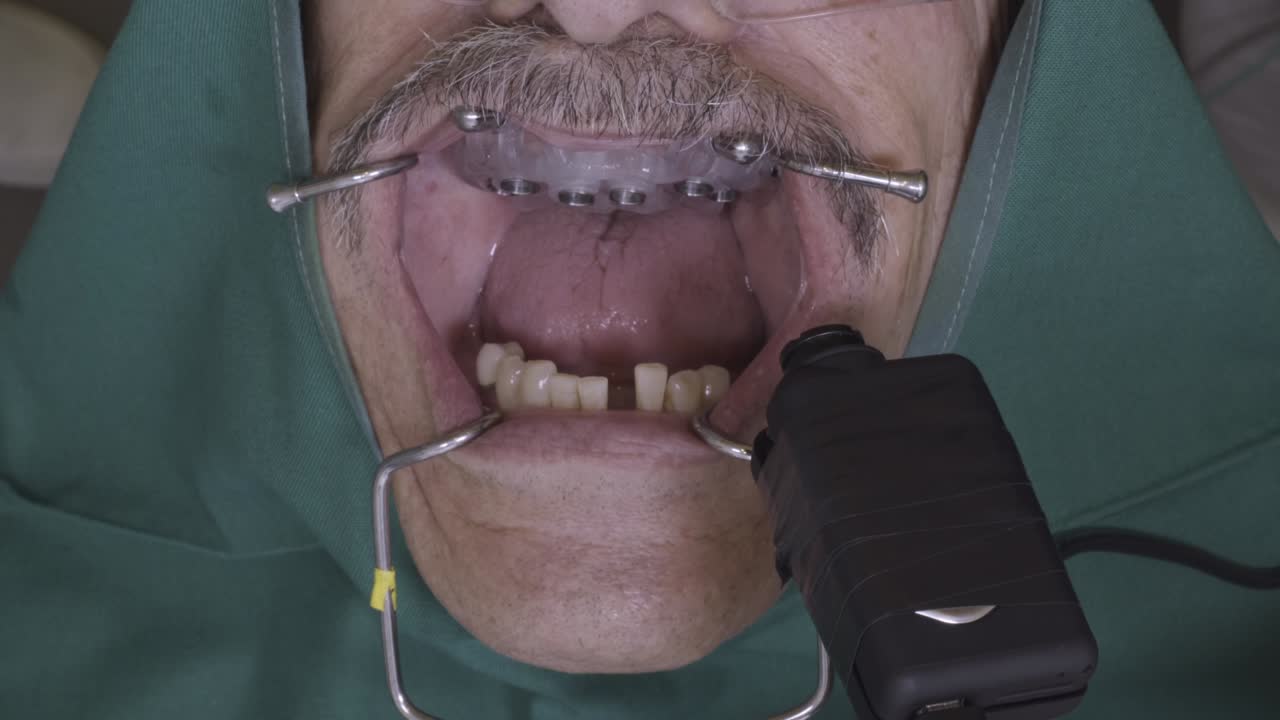 Close-up view of a senior man's mouth during a dental implant procedure