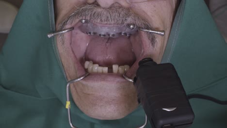 close-up view of a senior man's mouth during a dental implant procedure