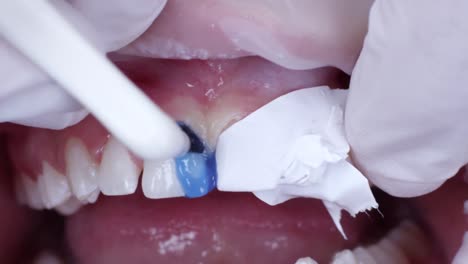 dentist apply acid itch blue gel on mesial aspect of central incisors teeth during diastema closure dental procedure, close up