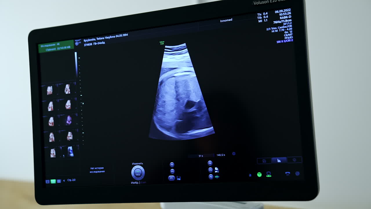 Ultrasound Image of a Fetus