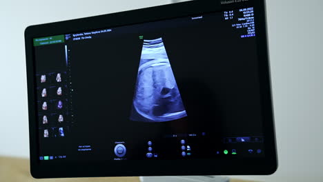 ultrasound image of a fetus