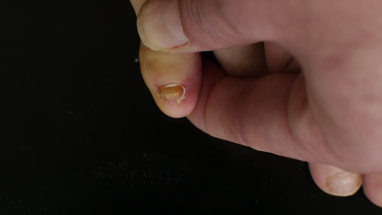 Close-up of a moist cloth gently cleaning an infected pinky toenail after filing, on a black background