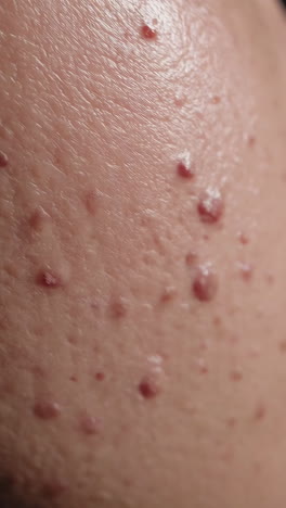 close-up view of skin with acne and bumps