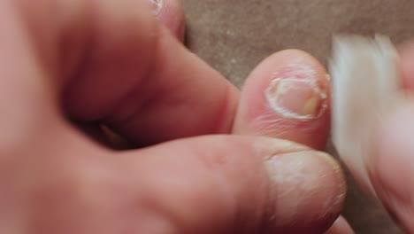 Moist-cloth-gently-cleanses-infected-toe-nail-and-skin