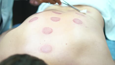sesión de terapia de ventosas