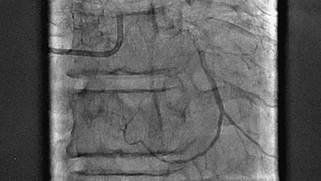 radiografía de angiograma médico de un corazón latiendo, examen de diagnóstico y tratamiento en un hospital