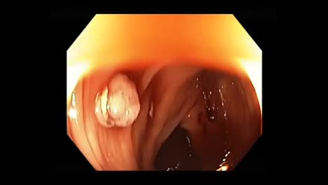 precancerous polyp in the colon found and removed during colonoscopy procedure for analysis