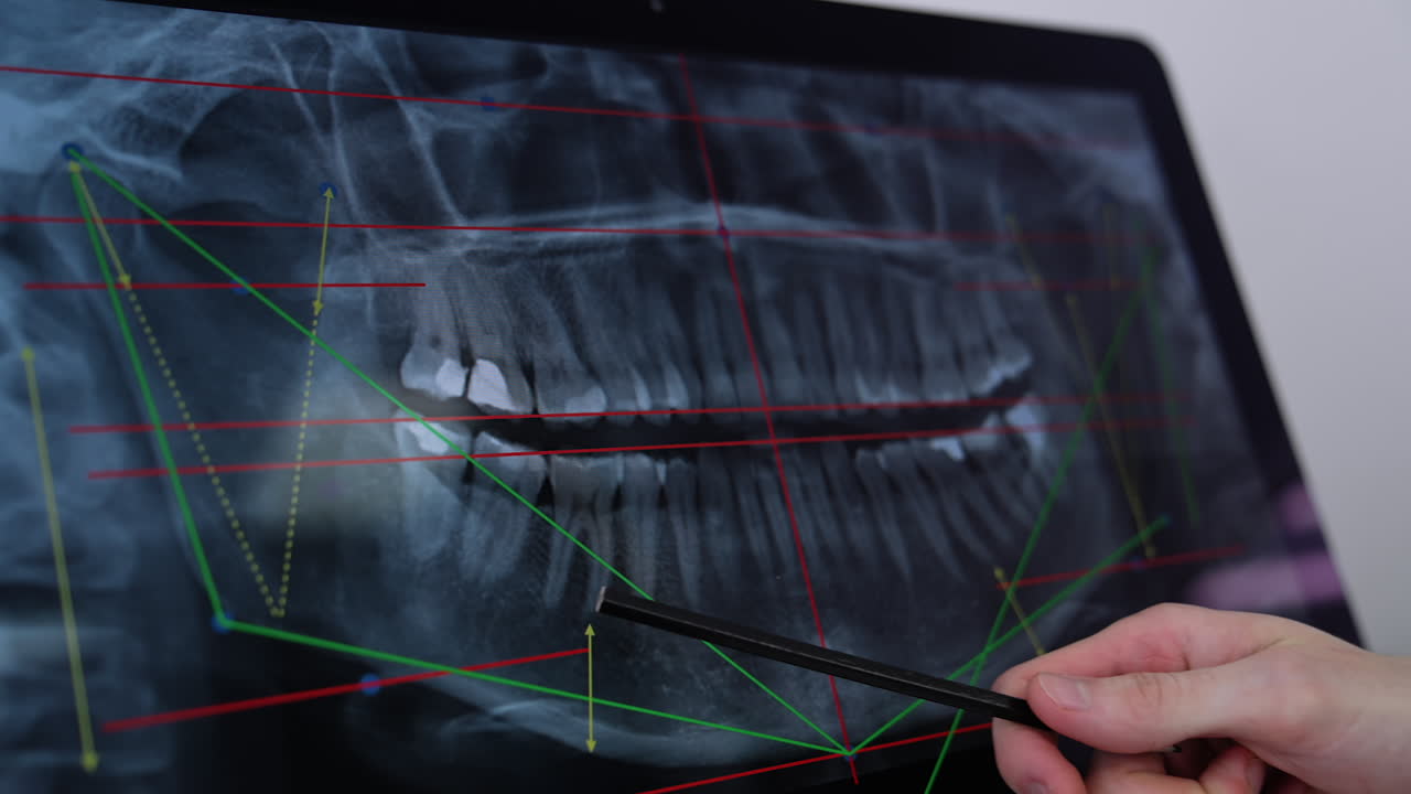 Dental X-Ray Analysis