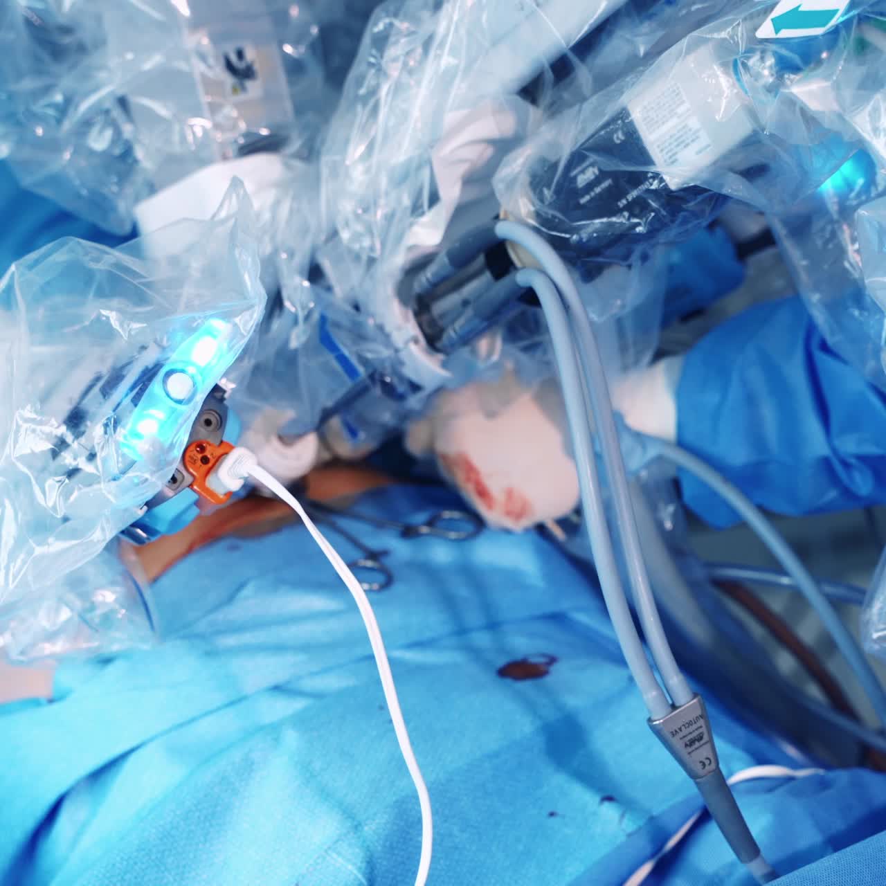 Contemporary equipment during the surgery. Machine part of robotic device on patient's body. New technology in medicine. Close-up.