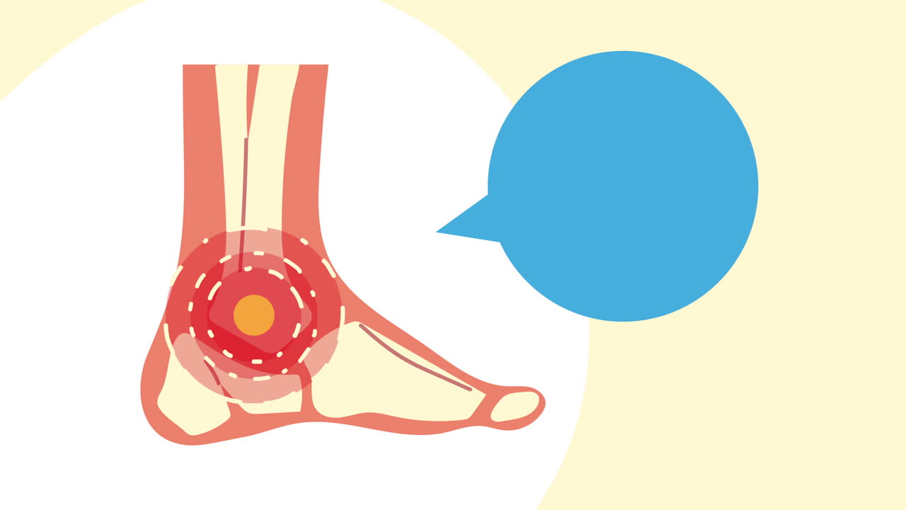 발목 통증, 류마톨로지, 질병 애니메이션