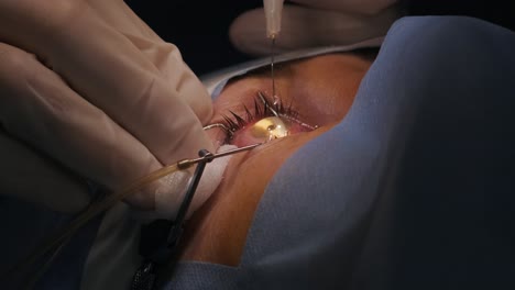 laser vision correction. a patient and team of surgeons in the operating room during ophthalmic surgery. eyelid speculum. lasik treatment. patient under sterile cover