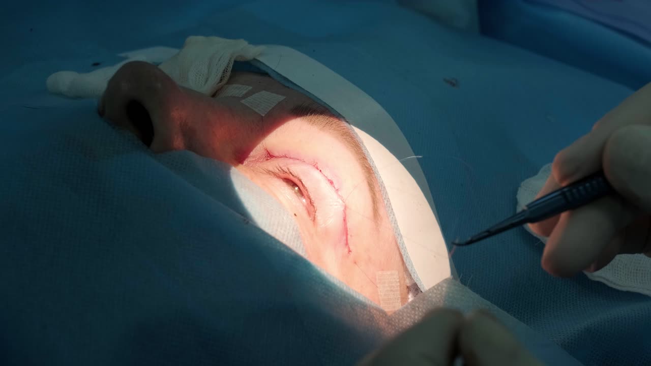 블레파로플라스티 (blepharoplasty) 는 눈 영역의 재생과 변형에 초점을 맞춘 성형수술입니다.
