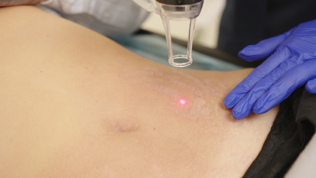 복부에 대한 레이저 피부 치료