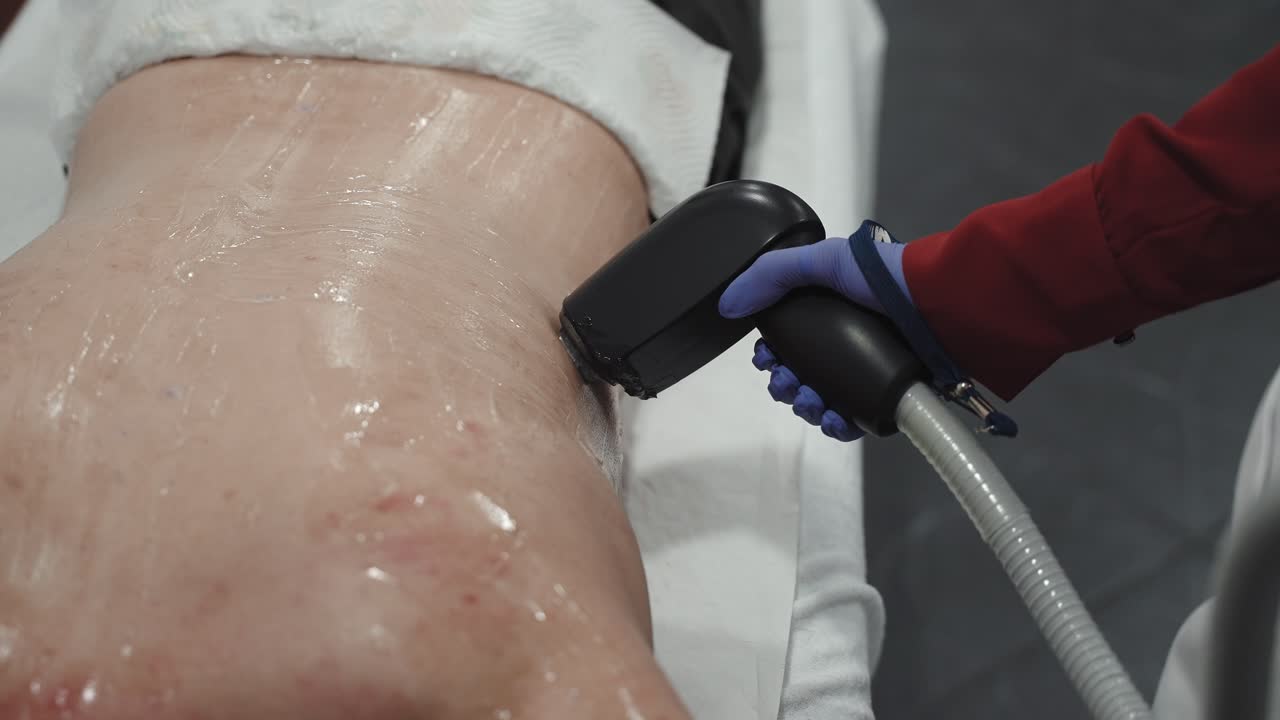 남성의 등에서 레이저 제거 치료