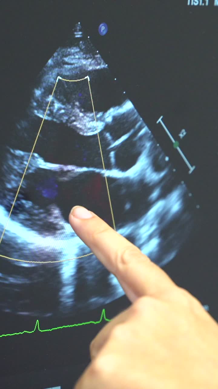 Immagini ecocardiogramma per la valutazione cardiaca