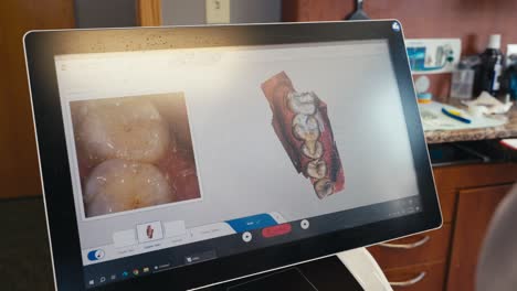 un dentista usando una máquina de escaneo de dientes 3d en un paciente, con el escaneo apareciendo en una pantalla