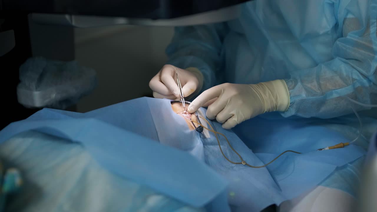 corrección de la visión con láser. un paciente y un equipo de cirujanos en la sala de operaciones durante una cirugía oftalmológica