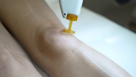 cosmetologist makes apotrixosi laser hair removal on legs of a woman - close up