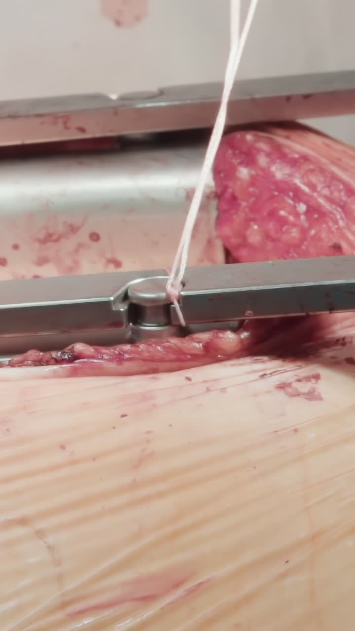 il medico mette dei fili sul retrattore. il chirurgo si prepara a chiudere i muscoli usando suture sterili dopo un successo di bypass coronarico