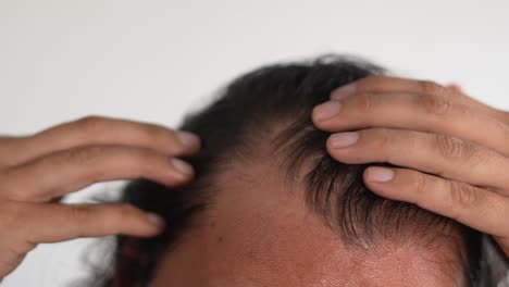 black-haired man with baldness,minoxidil, long hair