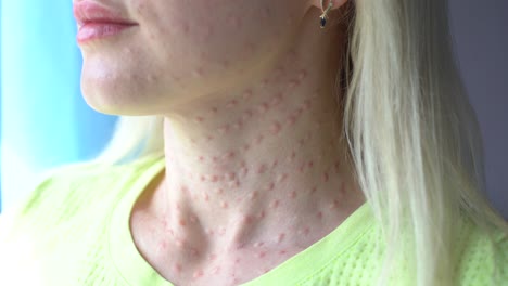 pápulas después de inyecciones de belleza en la cara. foto de cerca