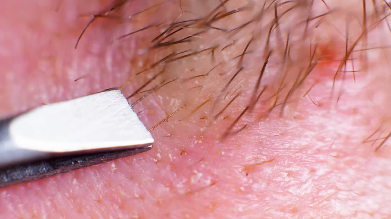 스튜디오에서 극도로 가까운 백인 사람에게 족집게로 머리카락을 제거하는 4k 슈퍼 매크로 샷