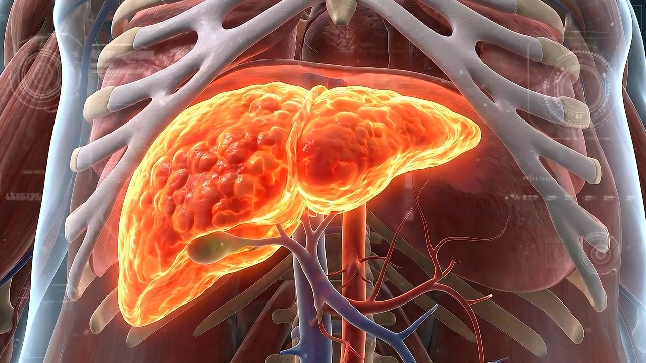 3D Medical Animation of a Diseased Human Liver