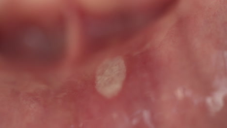 extreme macro shot of a aphthous stomatitis or canker sores in the mouth of a young man