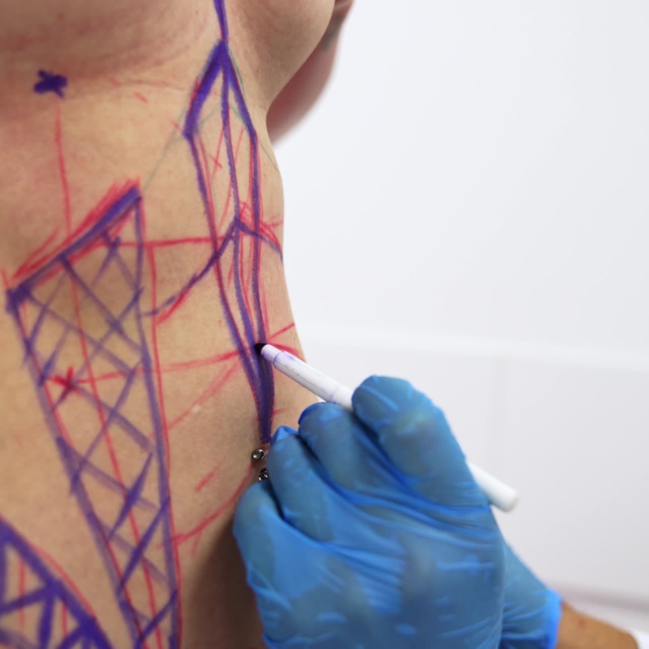 Surgeon's hand draws the red and blue lines on the belly. Patient's abdomen being prepared for liposuction operation