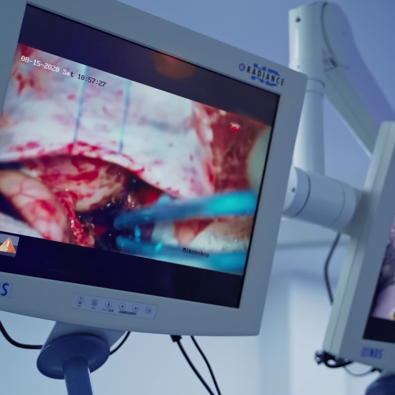 Detailed surgery on the screen. Medical monitors show the operating process with patient's organs in the operating room. New technology in medicine. Close-up.