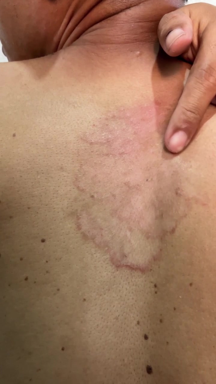 Primo Piano Verticale al Rallentatore di una Mano che si Gratta una Grande Eruzione Cutanea Rossa e Pruriginosa di Tigna sulla Schiena di una Persona. La Pelle Mostra una Grave Infezione Fungina, Allergia o Dermatite che Causa Disagio