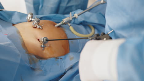 procedimiento de cirugía abdominal laparoscópica
