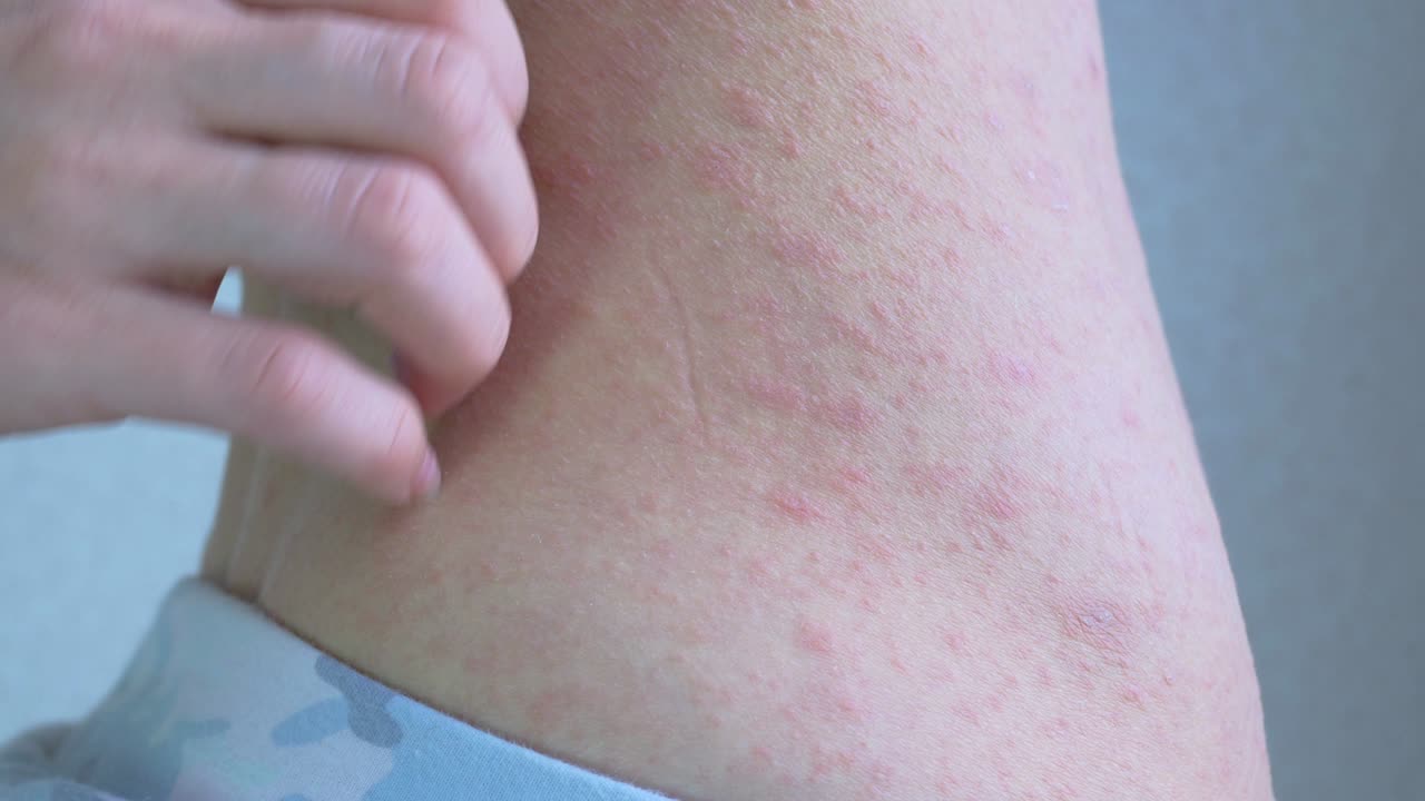 복부 구의 측면의 클로즈업, 아갈레네 영역은 병적 요소로 완전히 여 있습니다. 얼룩은 빨간색이고 크기가 다릅니다. 바이러스 질환. 피부에 가려움증.