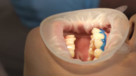 dental procedure with mouth open