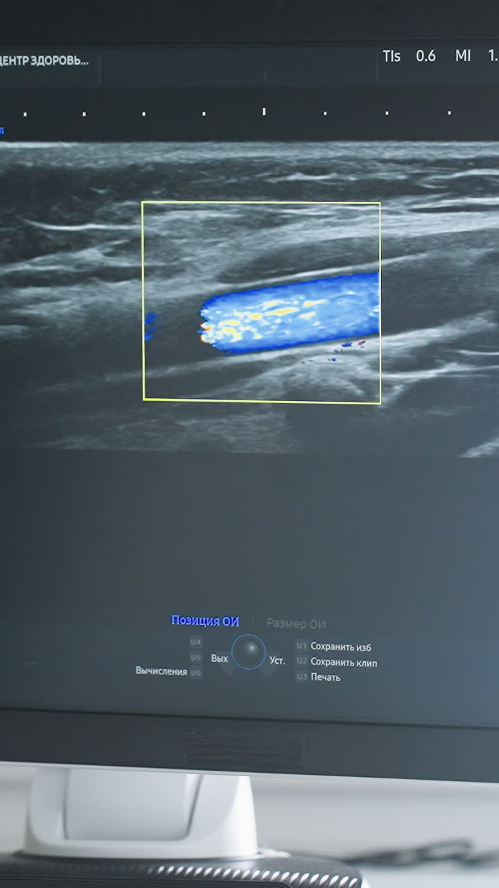 ultrasound monitor displaying color Doppler flow, boxed region highlights blue and red signals within vessel vascular sonographer performs carotid assessment and records spectral waveform