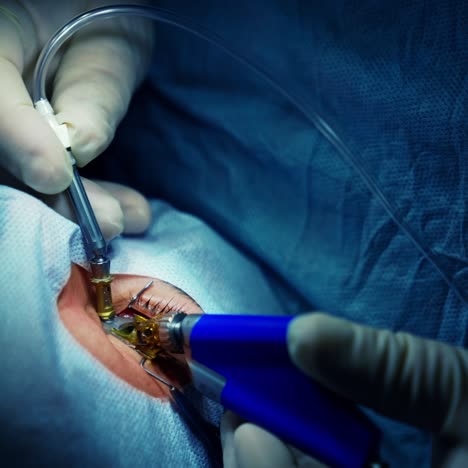 surgeon performing eye operation. ophthalmologist operating eye of patient in medical clinic